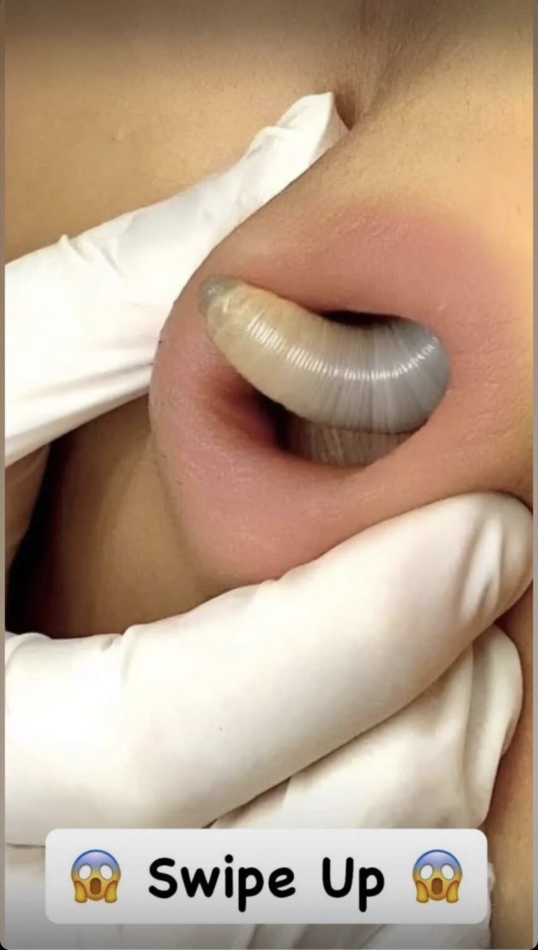 Why You Keep Getting Pimples Inside Your