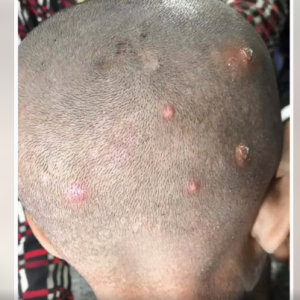 I Found Strange Bumps on My Son’s Head