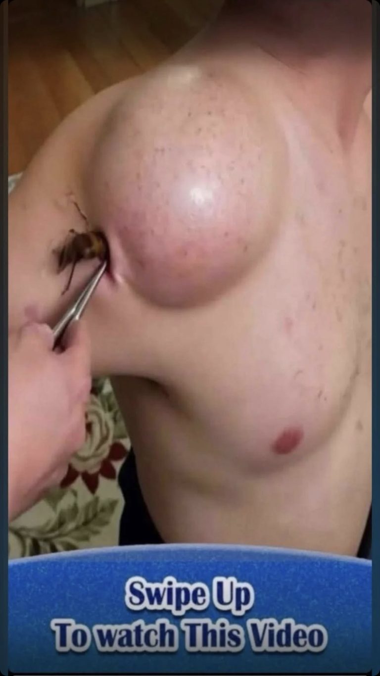 Their acne is severe