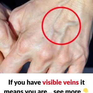 When to Worry About Veins That Appear