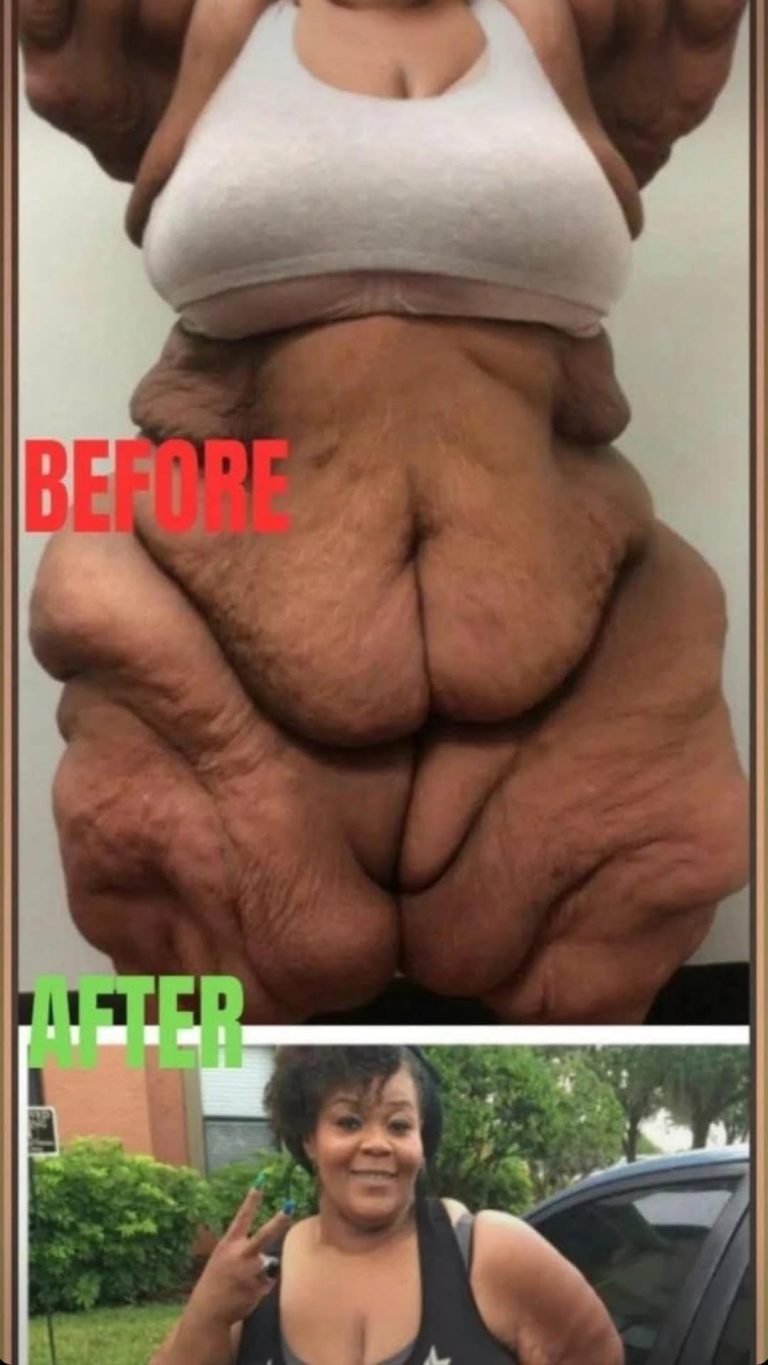 World’s heaviest woman who weighed 50 stone now