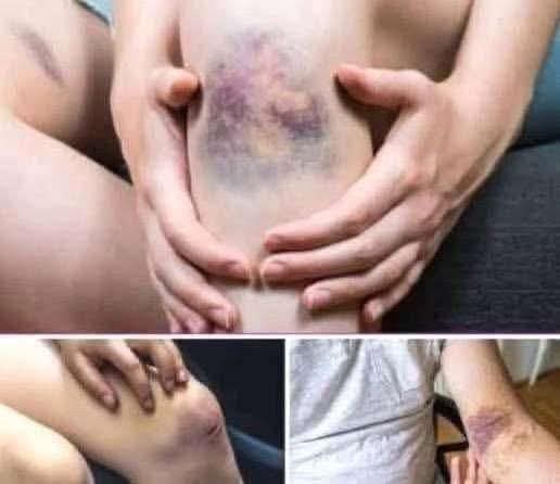 BE CAREFUL, if you get these bruises on
