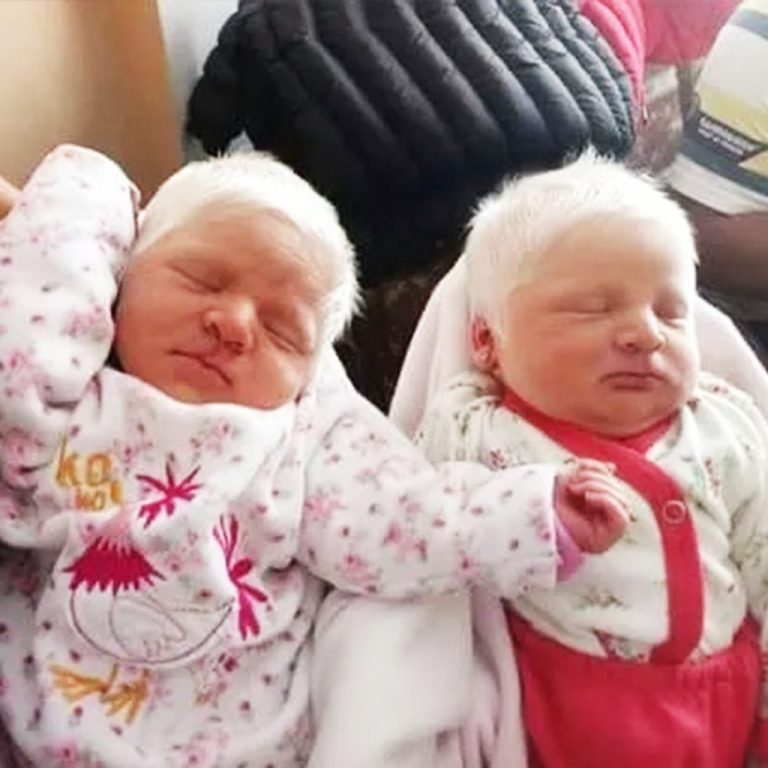 The First Ever Albino Twins Born In