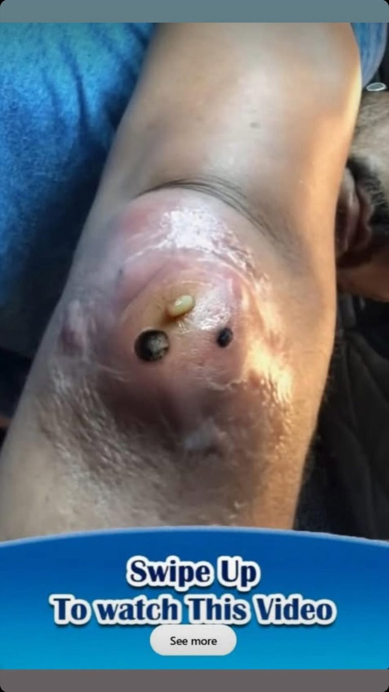 ST, Removal of a fairly large epiderm