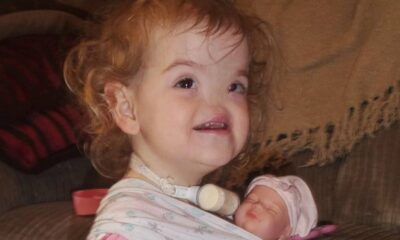 Born Without A Nose, Here’s What Tessa Evans