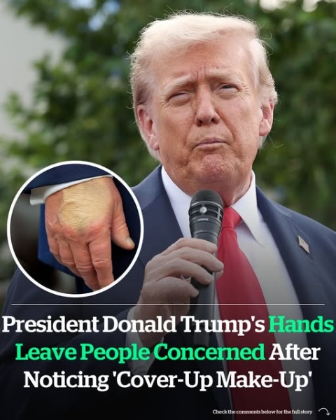 President Donald Trump’s hands leave people concerned