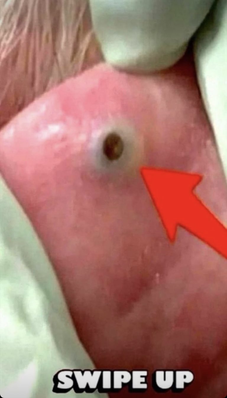 The Spot That Almost Killed