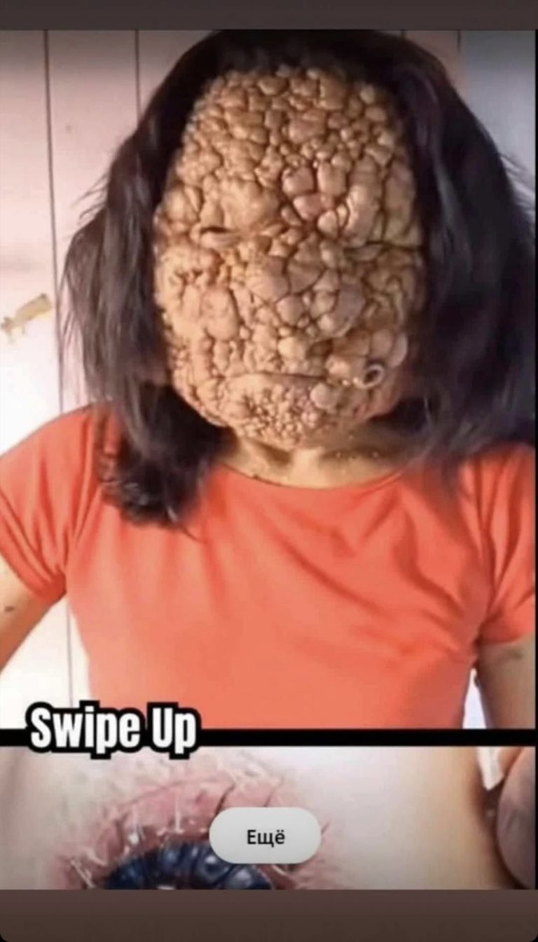 Acne occurs when hair follicle