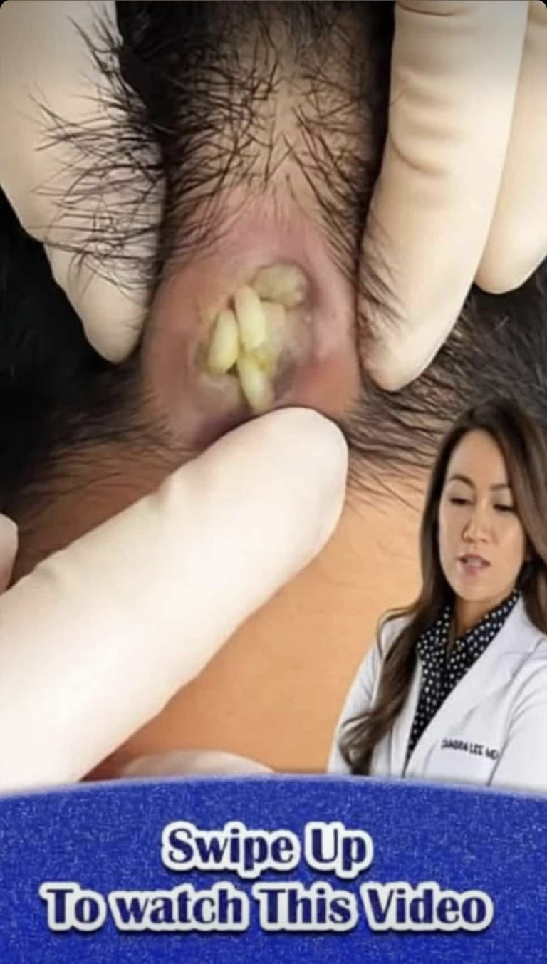 Their acne is severe