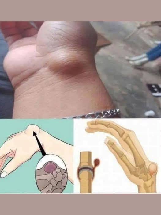 If You Get These Bruises on Your Body,