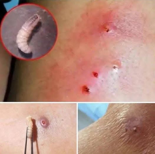 Larvae Found in Young Woman