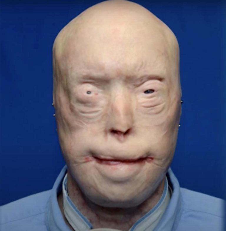 Firefighter Has Face Transplant After T