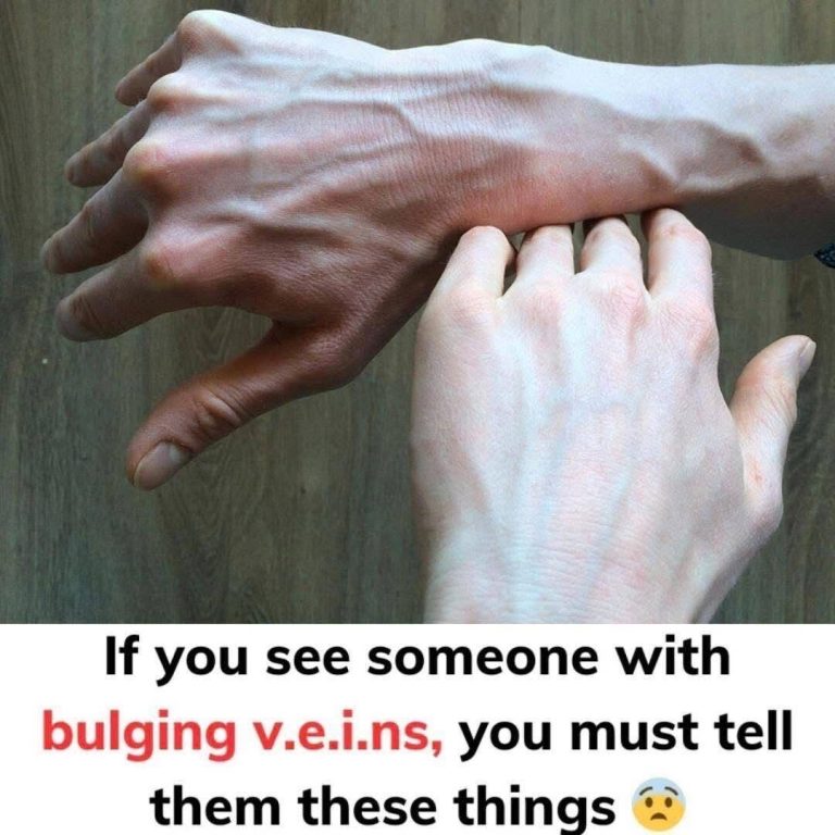 If you see someone with bulging veins