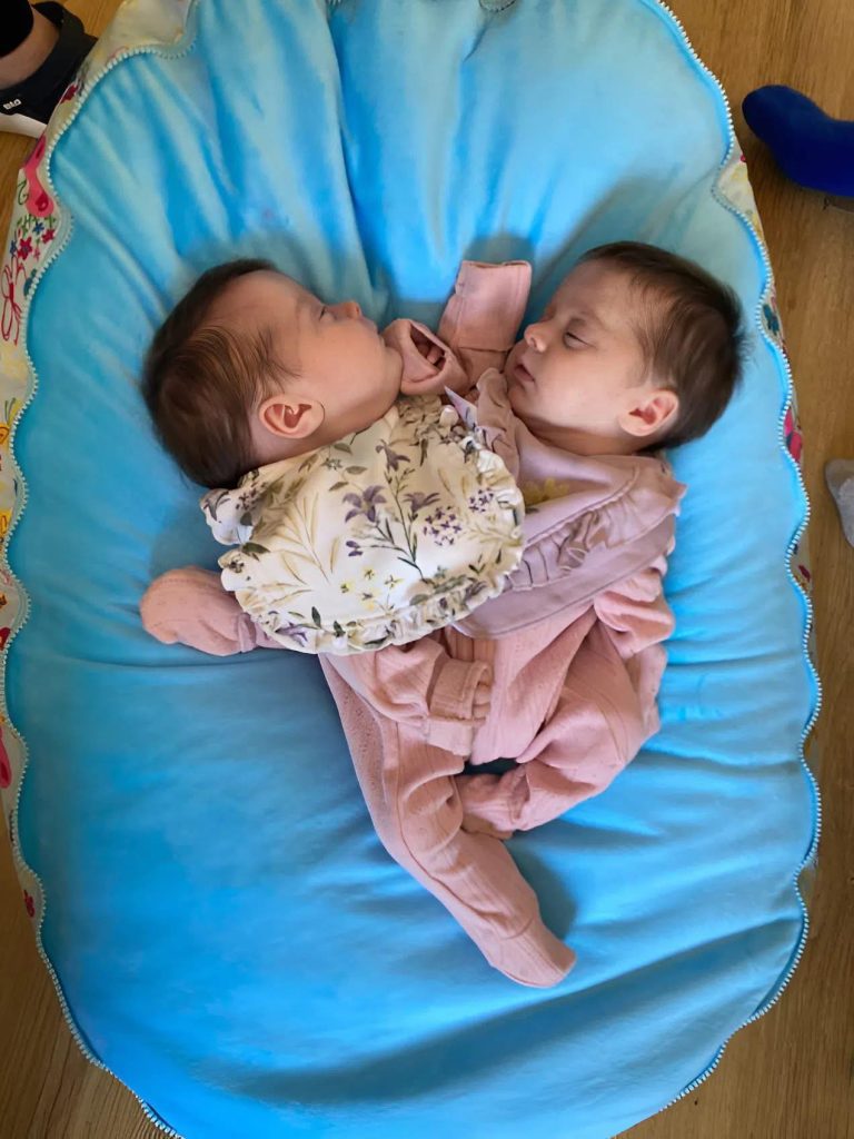 Doctors separated conjoined twins