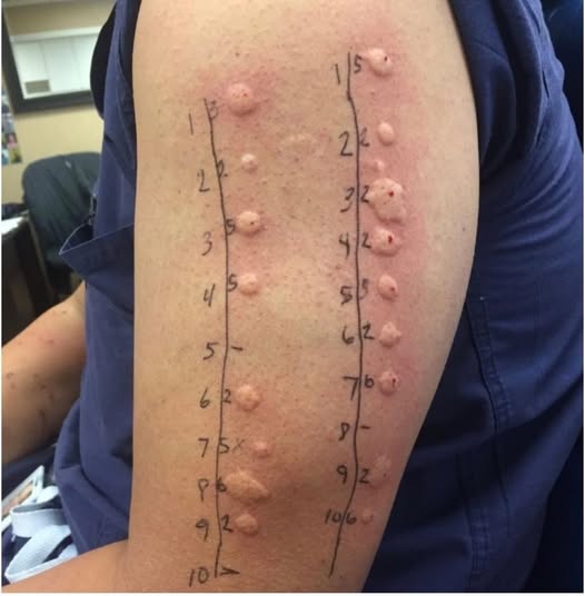 Common Causes of Genital Skin Bumps