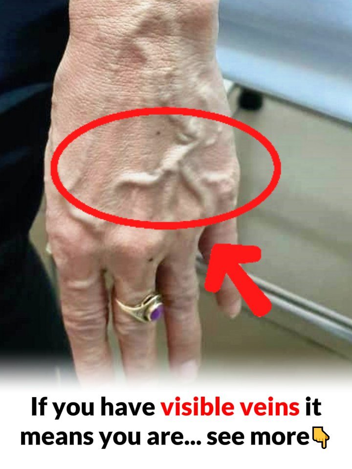 When to Worry About Veins That Appear