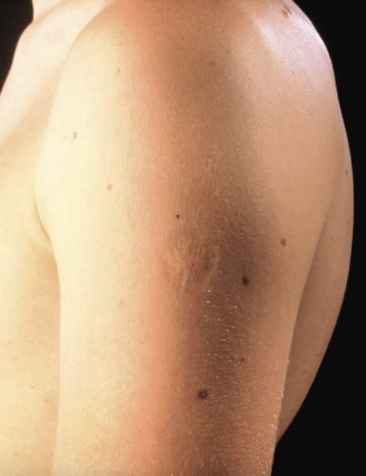 Smallpox vaccine scars: What they look