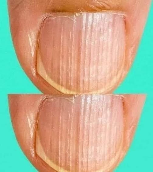 Having Striped Nails Could Mean That