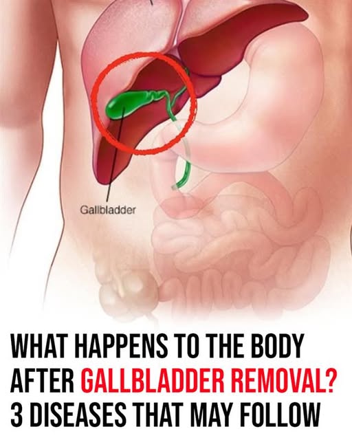 What happens to your body after gallbladder is removed