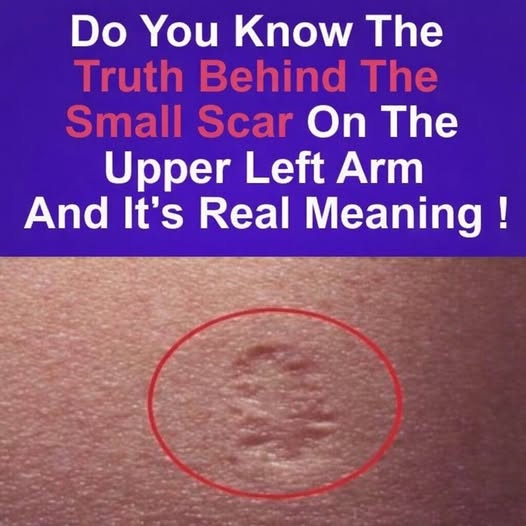 Smallpox vaccine scars