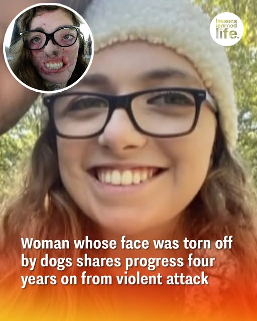 Woman whose face was torn off by dogs