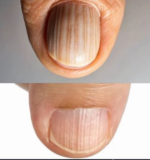 Having striped nails might be..