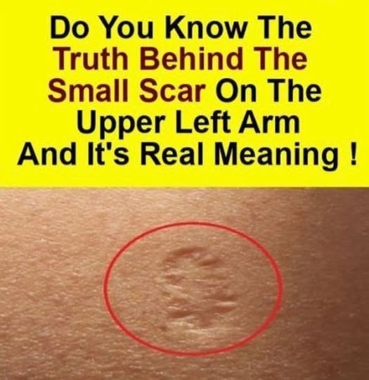 Smallpox vaccine scars: What t