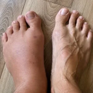 If your feet swell, it is a clear sign that…